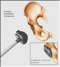 Implantace acetabulární komponenty.