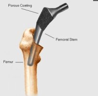 Implantace dříku do dřeňového kanálu stehenní kosti.